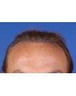 After Hair Transplant &nbsp;2 Sessions (Areas)